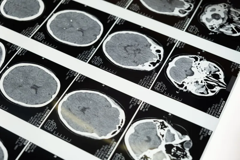 When the Diagnosis Is Wrong: Understanding Why CJD Is Frequently Overlooked and What Newark Patients Can Do About It