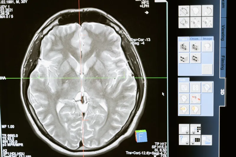 When Sleep Becomes a Clue: How Overlooked Sleep Disorders Are Delaying CJD Diagnoses in Newark
